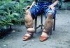 800px-Elephantiasis.jpg