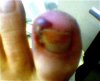 Hangnail-picture.jpg