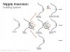 14_Diagram_Grading__Inverted_Nipple-01.jpg