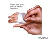 Easy-Home-Remedies-For-Minor-Burns.jpg