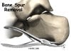 foot_plantar_fasciitis_surgery01.jpg