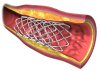 stent.jpg