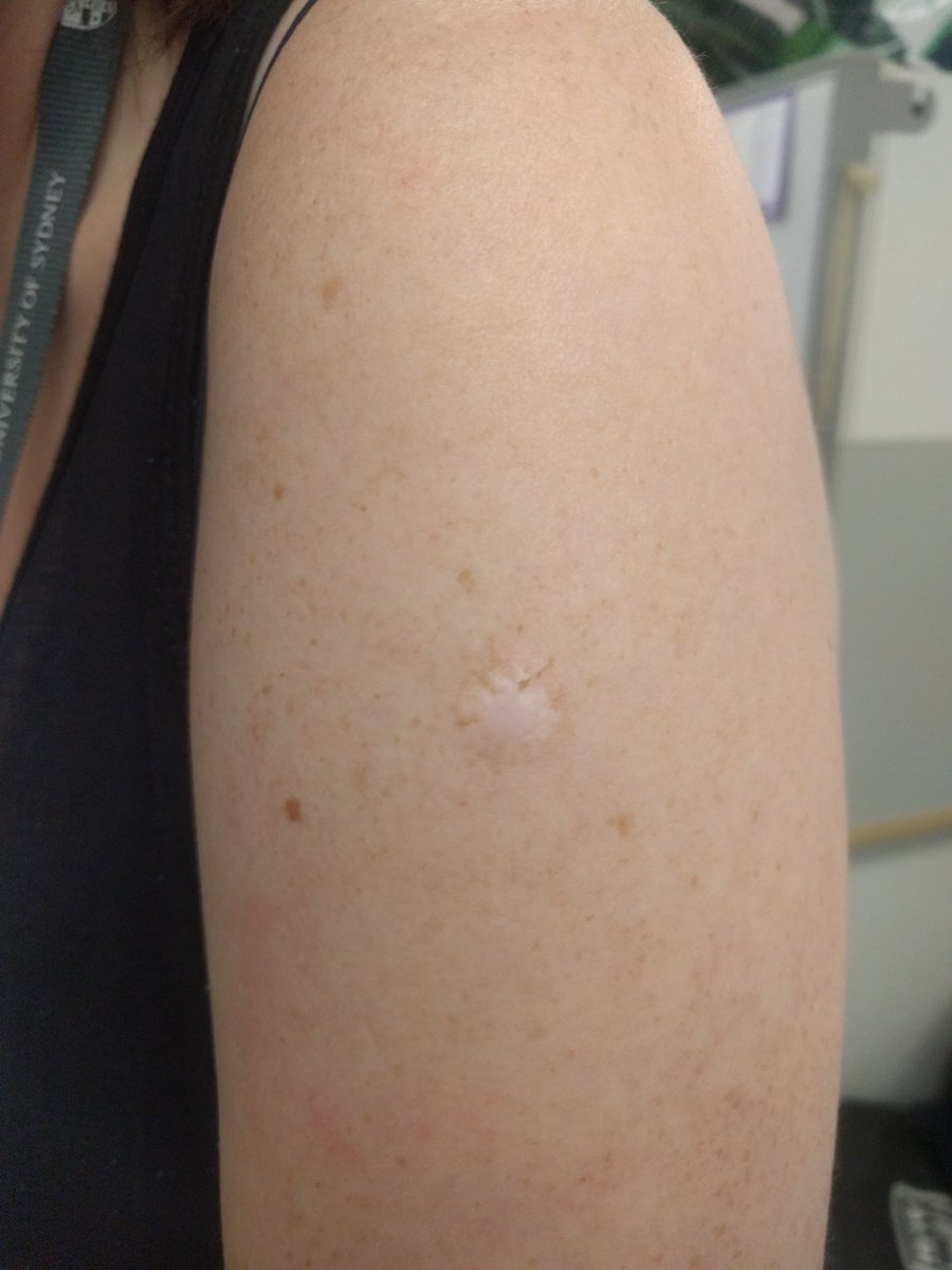 Image result for smallpox arm vaccination scar gif